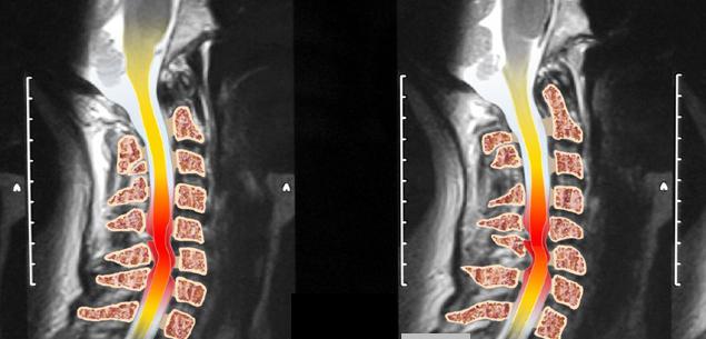 Aceasta arată coloana vertebrală lombară-sacră RMN 
